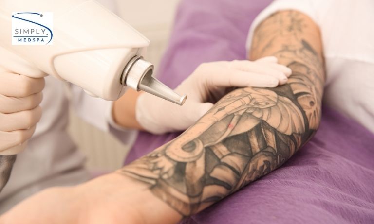 Laser tattoo removal treatment is being performed at Simply MedSpa in Colorado Springs medspa